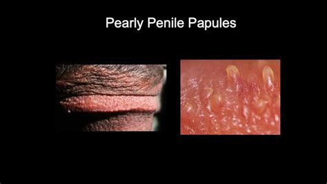 Pearly penile papules